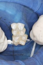 OptraDam Plus Small ref/50 - Image 3